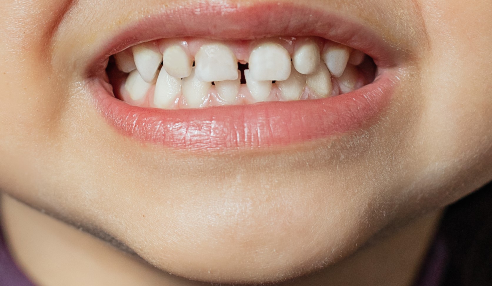 The child shows milk teeth with stains and plaque close-up. Two photos before and after. Children's dentistry. Health and dental care, caries treatment, baby teeth. Dark spots on teeth