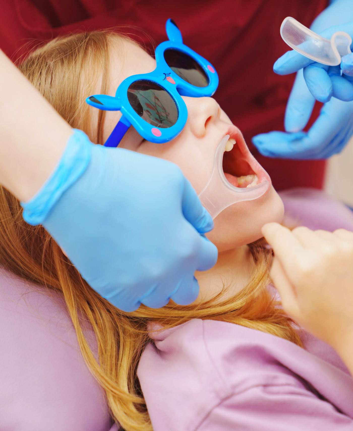 The pediatric dentist installs cheek and lip retractor for takes photos of the teeth before or after treatment. Dental photoprotocol in dentistry.